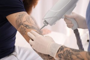 Read more about the article Choosing the Best Laser Tattoo Removal Course in the UK