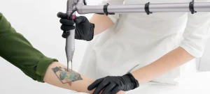 Read more about the article Unlocking Excellence: The Best Laser Tattoo Removal in the UK