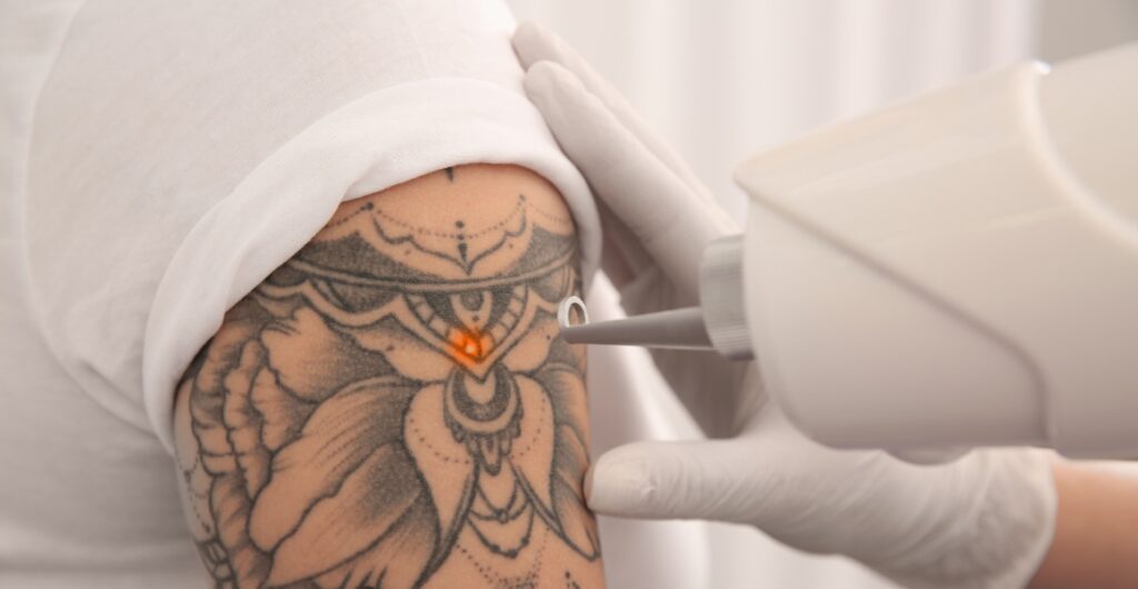 Best Laser Tattoo Removal Uk