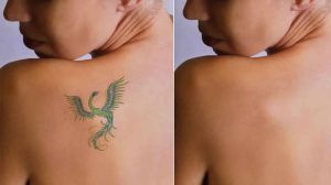 Read more about the article Understanding the Basics: What is Laser Tattoo Removal?