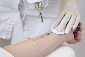 Read more about the article Exploring Laser Tattoo Removal Education in the Seaside City