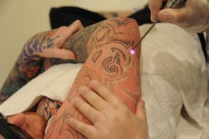 Read more about the article Mastering the Art of Tattooing: Laser Tattoo Removal Course