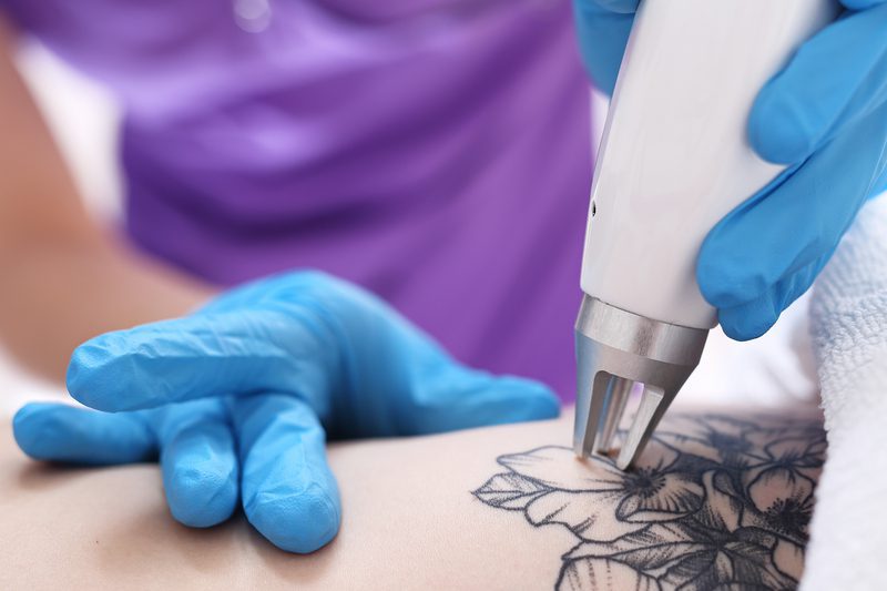 Best Laser Tattoo Removal Uk